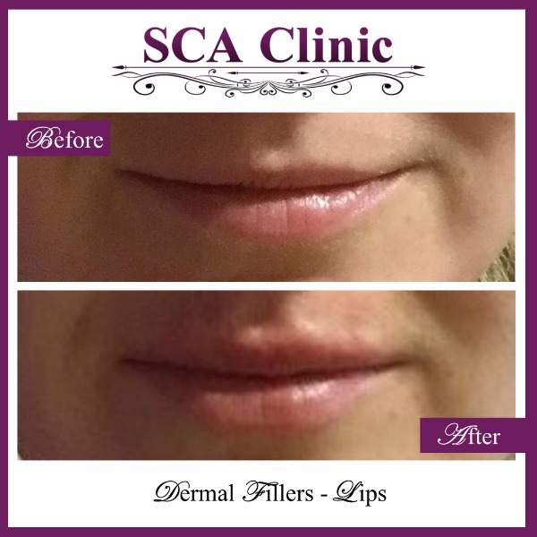 Dermal Fillers - Lips